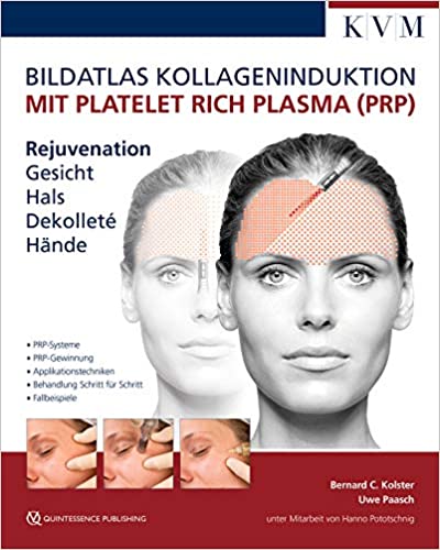 KVM BILDATLAS KOLLAGENINDUKTION MIT PLATELET RICH PLASMA (PRP) DR. PAASCH/DR. KOLSTER